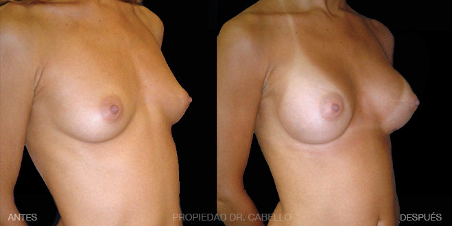 antes y despues de caso cirugia de aumento mamario